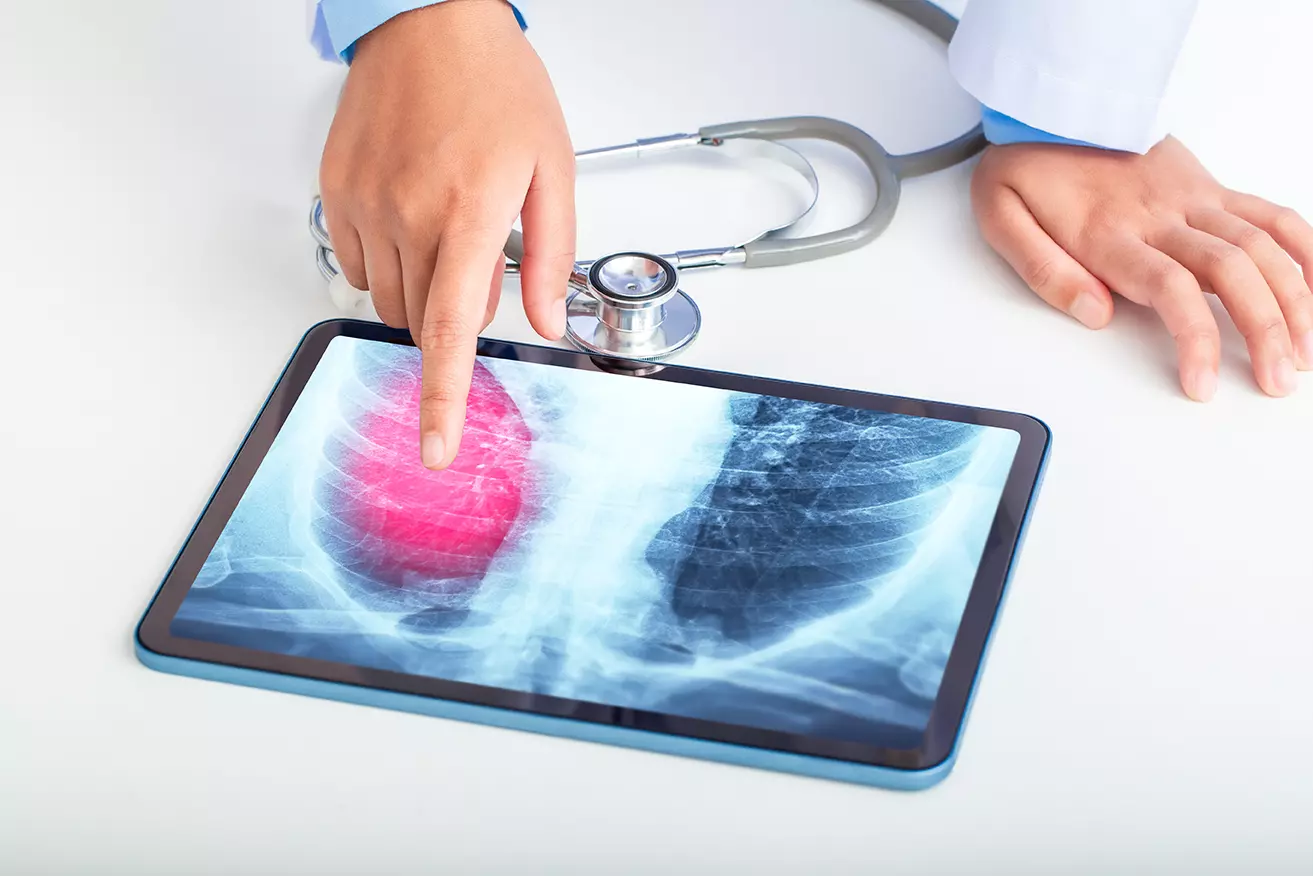 Doctor revisando en tableta un pulmón mostrando cómo la Inteligencia Artificial de Google puede predecir cáncer de pulmón